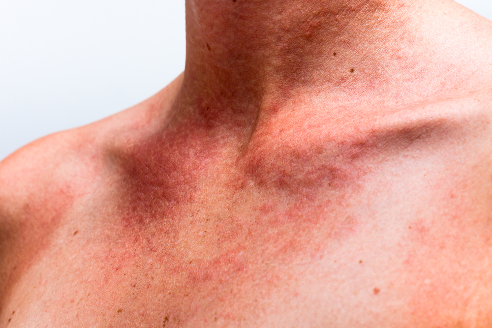 Close up of female sunburnt skin neck with allergic reaction.